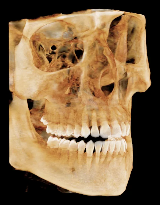 3D-beeld uit onze CBCT-scanner: de schedel met boven- en onderkaak en het volledige gebit, van opzij gezien