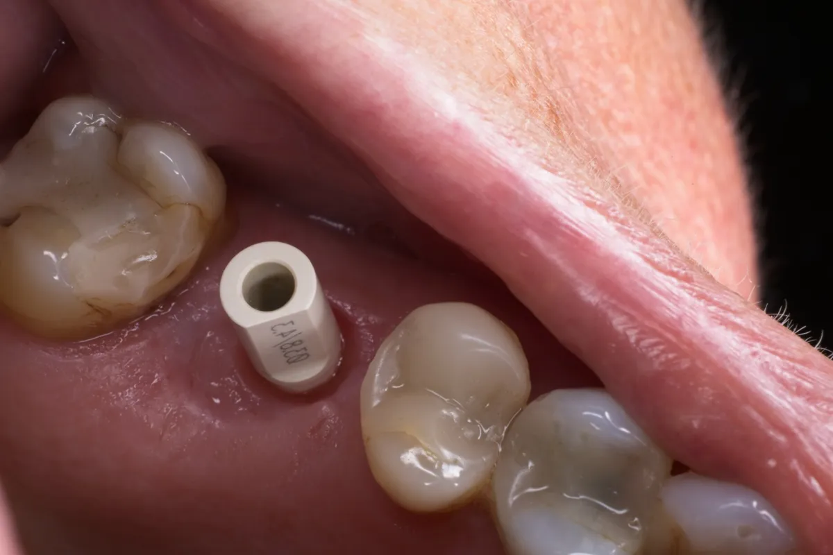 Witte scanbody op het implantaat, klaar voor de digitale scan