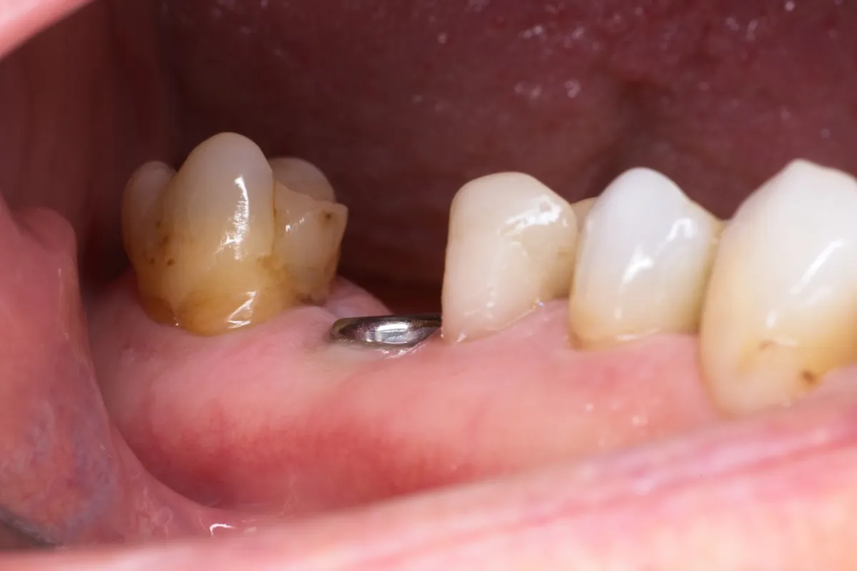 Klein metalen healing abutment op het implantaat, zijaanzicht