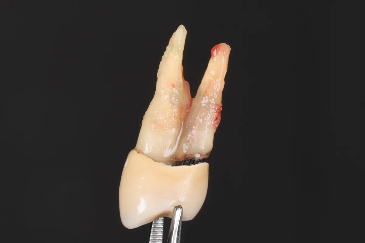 Een getrokken kies met een verticale wortelfractuur: de wortel is over de lengte gespleten